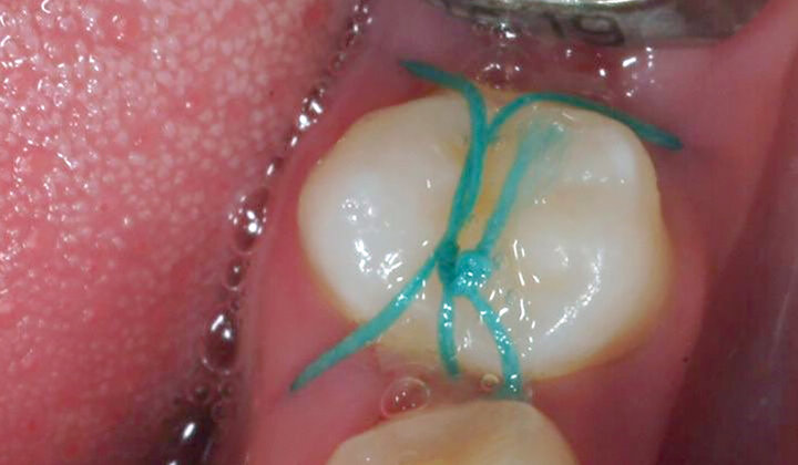 Autotransplantatie premolaren in de zijdelingse delen is voorspelbaar