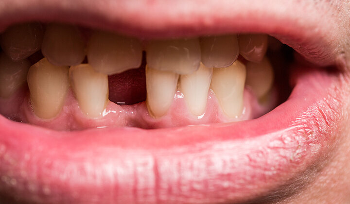 Tandverlies als marker voor algemene gezondheid 