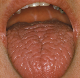 Droge mond en slikproblemen werken door na kankerbehandeling