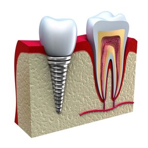 Subsidie voor onderzoek naar kwaliteit nieuwe tand-implantaten