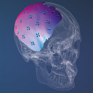 Autologe cranioplastieken geven hoge risico op infectie en resorptie