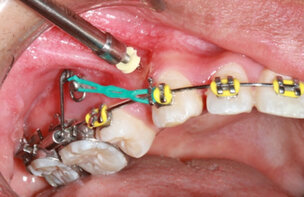 Botperforaties versnellen orthodontische tandverplaatsing