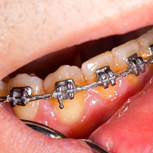Quaternair ammonium als antibacteriële coating voor orthodontische apparatuur