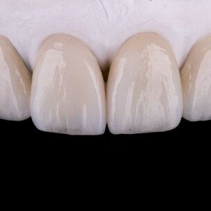Roken en endodontische behandeling van invloed op esthetiek veneers