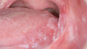Update van mond- en kaakziekten voor tandartsen