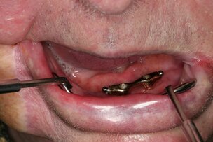 Implantaten gunstig bije dentate patiënten met mondkanker