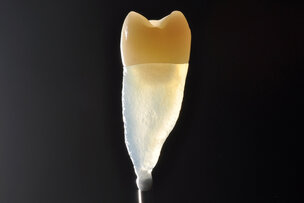 Minimaal invasieve tandheelkunde ook voor oude restauraties