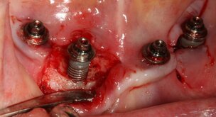 Implantaten en de kans op peri-implantitis