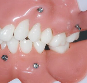 Het gebruik van implantaten in de orthodontie
