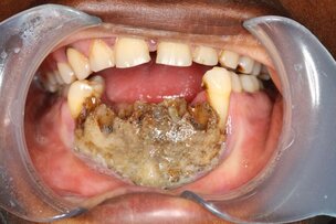 Waarom tandheelkundig onderzoek in Afrika onze blinde vlek is