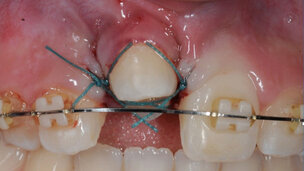 Autotransplantatie: het orthodontisch perspectief