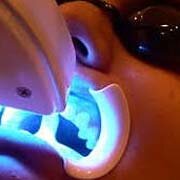 Toepassing van 35% waterstofperoxide in de tandheelkunde is niet zonder gevaar