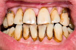 Parodontale behandeling weinig effectief bij zware rokers