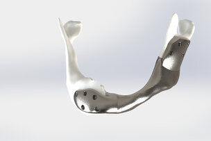 Eerste succesvolle operatie met 3D-geprinte titanium onderkaak